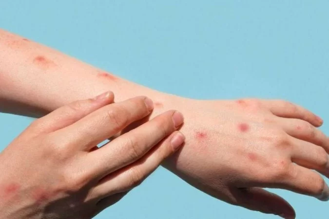 Confirmado caso de varíola dos macacos em Parobé