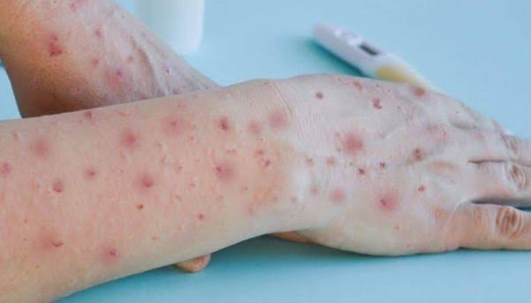 Estado confirma primeiro caso da varíola dos macacos em Igrejinha